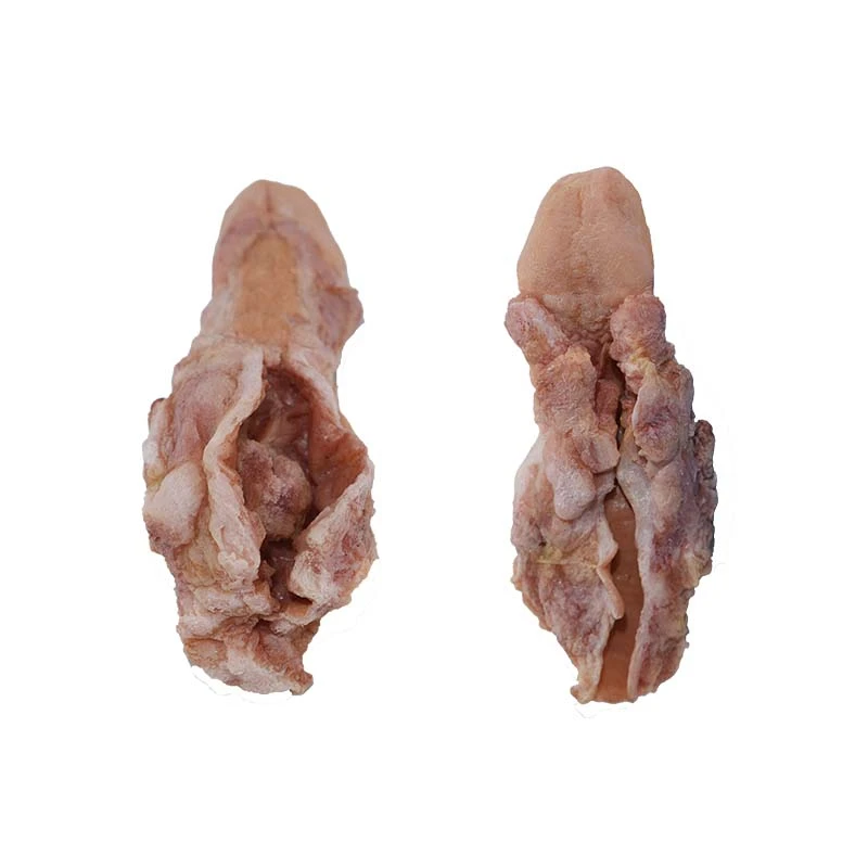Esophageal Cancer Model Esophageal Cancer Model